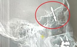 Bursa’da implant tedavisinde vida beynine saplandı